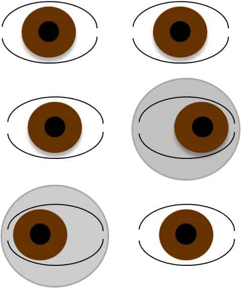 turned or crossed eye Different types of strabismus (By Connie Koklanis (Own work) [CC BY 3.0 (http://creativecommons.org/licenses/by/3.0)], via Wikimedia Commons)