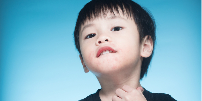 Asian boy has milk allergy which he might outgrow